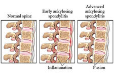 Physcial Therapy for Ankylosing Spondylitis