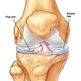 Physcial Therapy for Torn Cartilage (Meniscus Tear) 