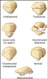 Chipped patella shop symptoms