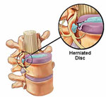 Physcial Therapy for Herniated-or-Prolapsed-Disc