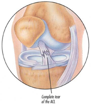 Treatment For Torn Anterior Cruciate Ligament (ACL Tear)